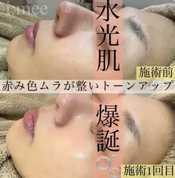 ハイドラ+スノーピーリング