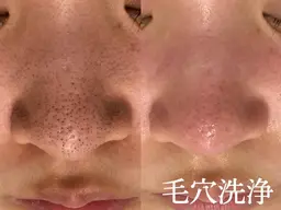 【11/25～28限定/再来◎】BLACK FRIDAY！前頭筋マッサージ付き全顔3D毛穴洗浄￥7700→¥5980