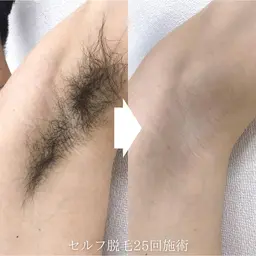 【脱毛】セルフ脱毛30分間打ち放題！時間内ショット無制限で好きなだけ👍🏻⸒⸒ 顔/腕/脇/脚...