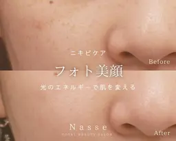 💎たるみ＆毛穴ケア・改善💎フォト美顔＋イオン導入1種　\8800　　[福岡/赤坂]