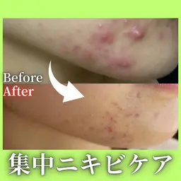 ＼繰り返すニキビにお悩みの方に／9月30日まで限定❤️‍🔥夏の肌荒れ対策!!!!🥵