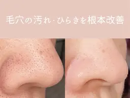 【韓国肌管理】毛穴洗浄ハイドラフェイシャル&剥離なしハーブピーリング🌿¥28,000→¥12,500