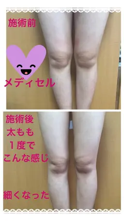 メディセル下半身！太もも、ふくらはぎ部分的に集中して引き締めたい