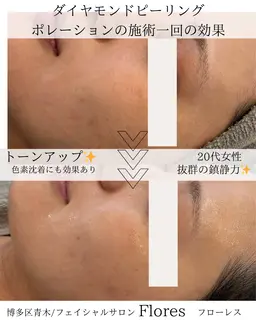 肌が変わる90分！毛穴洗浄×導入×集中ケアで圧倒的つるすべ肌へ🫧 お悩み別！毛穴洗浄・吸引・美容液導入・鎮静パックなど