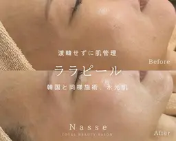 【韓国肌管理/毛穴/艶肌】ララピール（首込み）￥9800