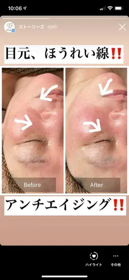 今！！話題の小顔フェイシャル‼️フェイスライン、二重アゴ、ほうれい線に！