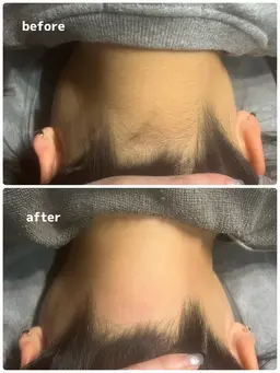 うなじ脱毛　光orWax