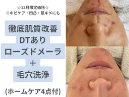 12月限定価格☆ローズドメーラ(全顔)＋毛穴洗浄/ホームケア4点付¥42850→¥32000