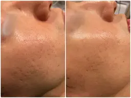 ララ洗顔+サーマトリックス(全顔+首)💉✨最新美容【小顔、たるみ、クレーター、肌のハリツヤ】DTなしで感動を💆♀️