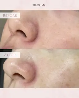 【3ヶ月後に毛穴ゼロを目指す！小鼻ワックス脱毛】