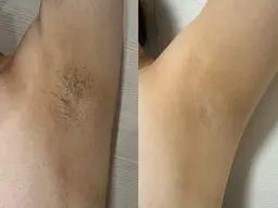 全身脱毛（顔・VIO込み）