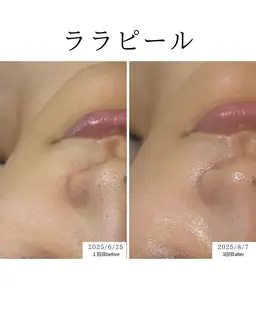 【大人気肌管理】韓国肌管理 水光艶肌ララピール¥9,800