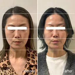 たるみの決定版！サーマトリックス全顔+首照射。