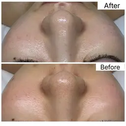 韓国予約半年待ち‼️今話題のTROIAREUKE(トロイアルケ)スキンメイド/毛穴汚れスッキリ