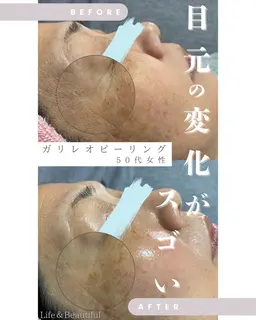【短期間集中🌟高濃度炭酸美容液ガリレオピーリング】嬉しい！デコルテマッサージ付き❣️