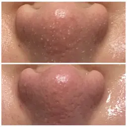 毛穴洗浄、保湿+ニキビケア 60分