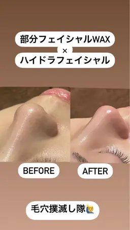 ✨メンズ 小鼻の黒ずみ 部分フェイシャルワックス小鼻×毛穴洗浄ハイドラフェイシャル ¥4400✨