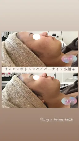 ハイパーナイフ小顔×最強美容液lemon bottle導入