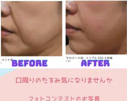 【最新マシンですっきり小顔】❤ヒアルロン酸増量うるツヤ美肌✨エンダモロジー フェイス✨