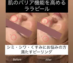 第4世代ピーリング🩵角質除去×水光肌ケア【ララピール 】