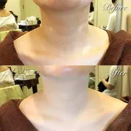 アザ・白斑・太田母斑などのカバーメイク練習モデル