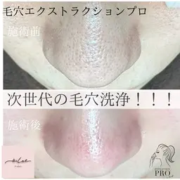 話題の毛穴エクストラクション→鼻の毛穴でお悩みの方必見！毛穴の汚れをオールハンドで施術し、毛穴詰まりを改善します。