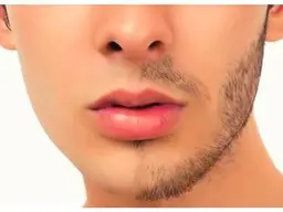 【全顔脱毛】男性モニター様限定