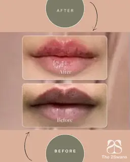【韓国正規取扱サロン Lemella　ルメラ】ピンクに～唇 黒ずみメラニンケア