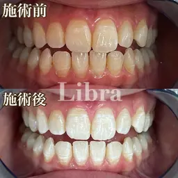 🫧セルフホワイトニング🫧初回体験10分×3回　​〜​安心のカウンセリング付き​〜​💛