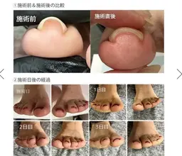 【巻き爪】痛み0ネイルをしながら巻き爪改善💎1本​〜​予約可能