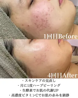 《ニキビ・毛穴が気になる方》ハーブピーリング＋VCF＋シルクパウダー(デコルテマッサージ付き)メンズ可