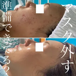 【ミニモ学割】ダウンタイムなし‼️ニキビでお困りの方にもおすすめ💕バクテリウムピール４回コース✨メンズOK🙆‍♀️
