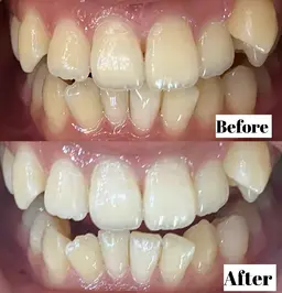 【⚘️16時まで限定⚘️】5分×3回照射のセルフホワイトニング