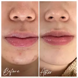 【顔◆人気No.1】剥けるハーブピーリングx鎮静パック