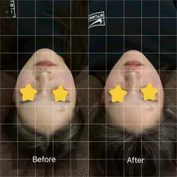 小顔矯正