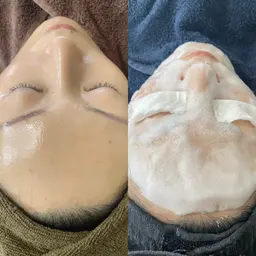 韓国肌管理/肌で弾ける/炭酸パック/フェイシャル¥6500