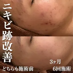 《長年繰り返すニキビ・ニキビ跡にお悩みの方》肌質改善トータルケア+～腸マッサージ付き～