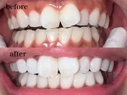 <初回限定>セルフホワイトニング30分¥3850