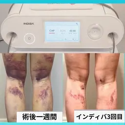 ⚠️予約確認必須【術後インディバケア60分】顏/ボディ、拘縮、内出血、ダウンタイム短縮!