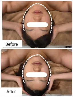 小顔矯正