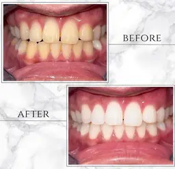 【ダントツの仕上がり】プレミアムホワイトニング30分照射×最高峰3色LEDライト効果抜群