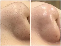 【憧れの美肌小顔✨】Vライン小顔矯正💎つるつるタマゴ肌ピーリング👸ハイドラフェイシャル《毛穴/テカリ/ニキビ/乾燥》