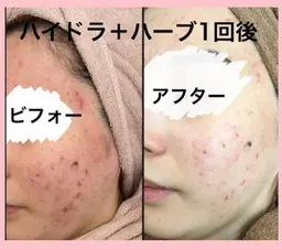 ミニモ限定‼️平日限定‼️モニター🌿ハーブピーリングフェイシャル＆角質洗浄4980円🌿剥離あり🌿午後5時まで