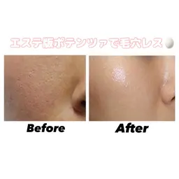 【毛穴ケア】毛穴洗浄×マイクロニードルで徹底的に毛穴ケア🥚✨️¥32,000⇒¥14,800
