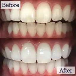 【初めての方にオススメ】8分照射×2回の定番メニュー💎セルフホワイトニングでお手軽に白い歯へ🦷美容の秋到来