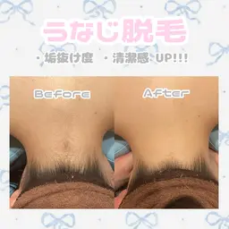 2026年成人式前うなじ脱毛👘🎍脱毛未経験の方大歓迎🥳着物を着るなら襟足の脱毛は必須です✨