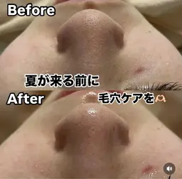 【リピート】水素ハイドラフェイシャル✨