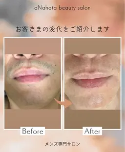 【水曜日・日曜日限定】men's顔脱毛（ヒゲを含む）