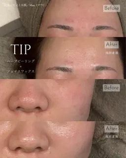 【ニキビケア】-お肌に優しいハーブピーリングで健康的な艶肌に🌿剥離せず、ダウンタイムもありません