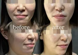 【1日2名限定】肌管理モニター🫧毛穴・ニキビ・赤み・ザラつき改善/フェイシャル歴6年以上のベテランスタッフ施術✨